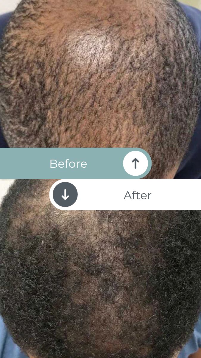 hairbeforeandafter2 Top Rated Massage + Wellness Center in San Luis Obispo